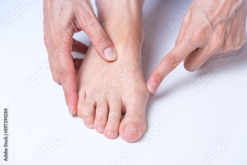 person showing bunion on his foot, close up