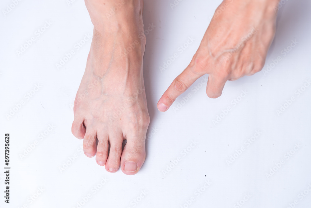 bunion on foot, arthritis, health, body medicine bunion on foot, arthritis, health, body medicine