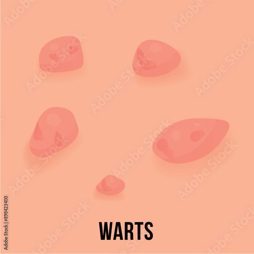 Illustration of multiple warts on skin