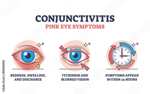 Conjunctivitis or pink eye symptoms with simple explanation outline diagram, transparent background. Labeled educational scheme with first appearance of redness, swelling.