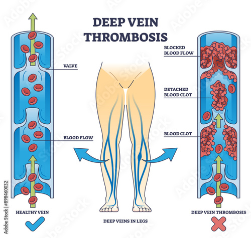 Deep vein thrombosis condition with blood clot blockage outline diagram, transparent background. Labeled educational comparison with healthy vein and dangerous flow illustration.