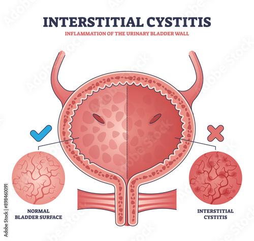 Interstitial cystitis as urinary bladder wall inflammation outline diagram, transparent background. Labeled educational urology problem and compared healthy bladder surface.