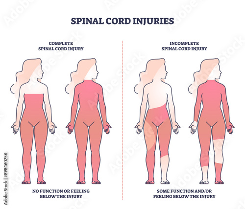 Spinal cord injuries with complete or incomplete trauma outline diagram, transparent background. Labeled educational scheme with function or feeling zones in state of paralysis illustration.