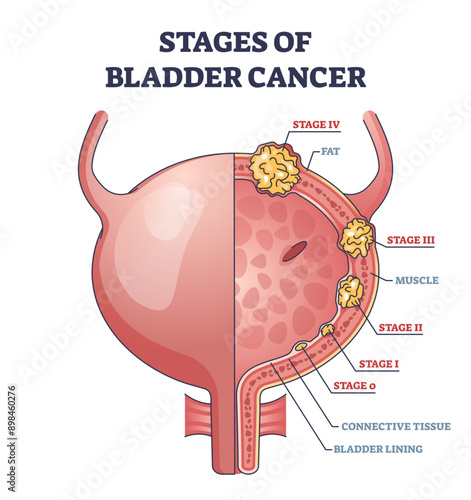 Stages of bladder cancer with anatomical oncology model outline diagram, transparent background. Labeled educational scheme with illness growth and medical condition development illustration.