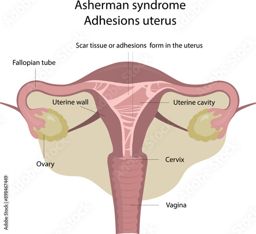 Asherman syndrome . Adhesions uterus.