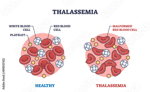 Thalassemia blood disorder caused by lack of hemoglobin outline diagram, transparent background. Labeled educational scheme with healthy red blood cells vs malformed illustration.
