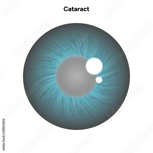 Cataract eye disease problem and green eye