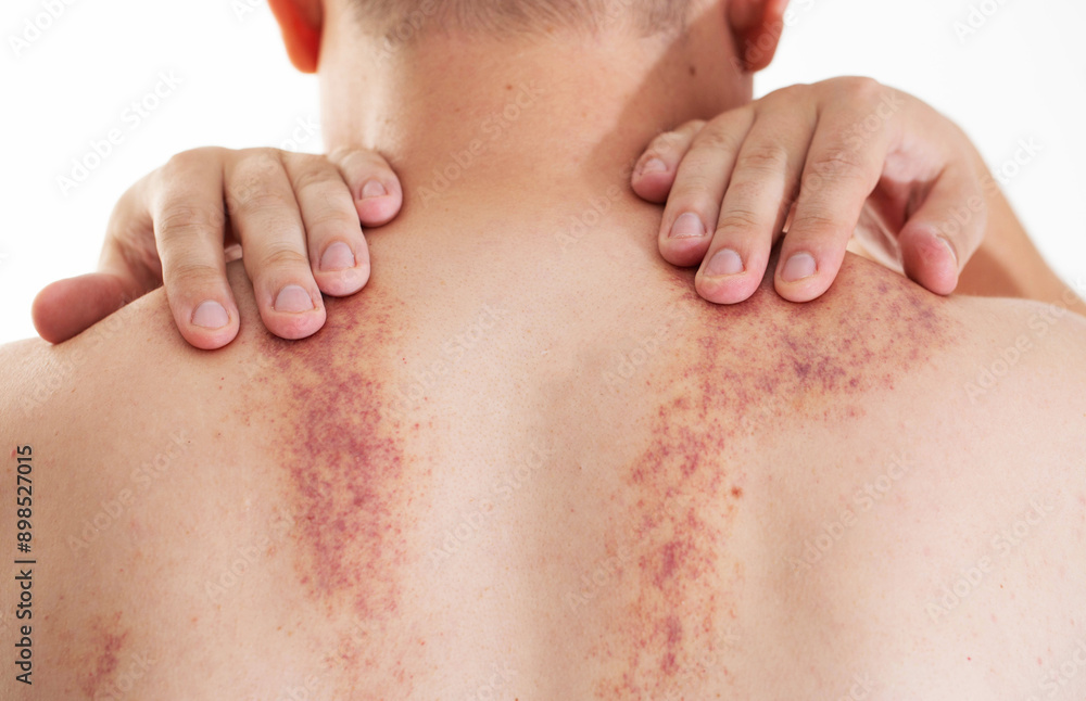 Marks on the skin of a man's back after a massage. Concept of improper massage, bruising and skin irritation, close-up, erythema Marks on the skin of a man's back after a massage. Concept of improper massage, bruising and skin irritation, close-up, erythema