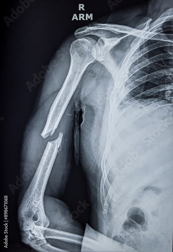 Fotografie X ray of upper arm showing fracture in the shaft of humerus bone