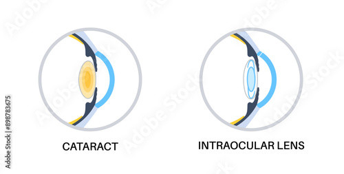 Intraocular lenses poster