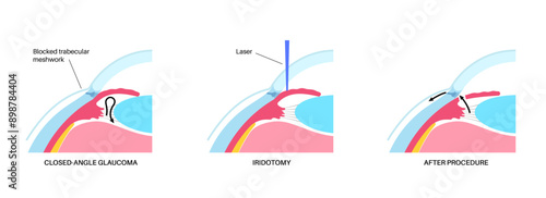 Iridectomy medical poster