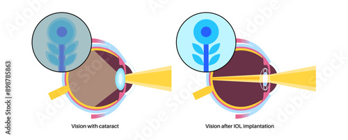 Intraocular lenses poster
