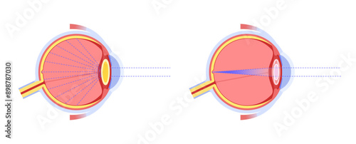 Intraocular lenses poster