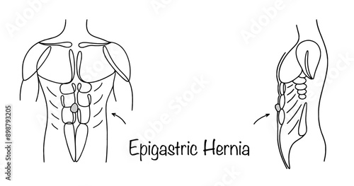 Epigastric Hernia