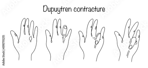 Dupuytren contracture photo