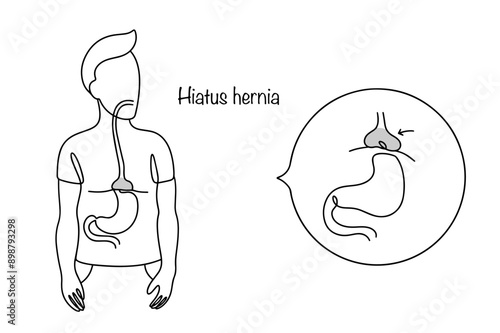 Hiatus hernia
