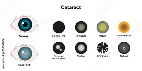 Type cataracts vision disorder problem with normal and cataract eyes