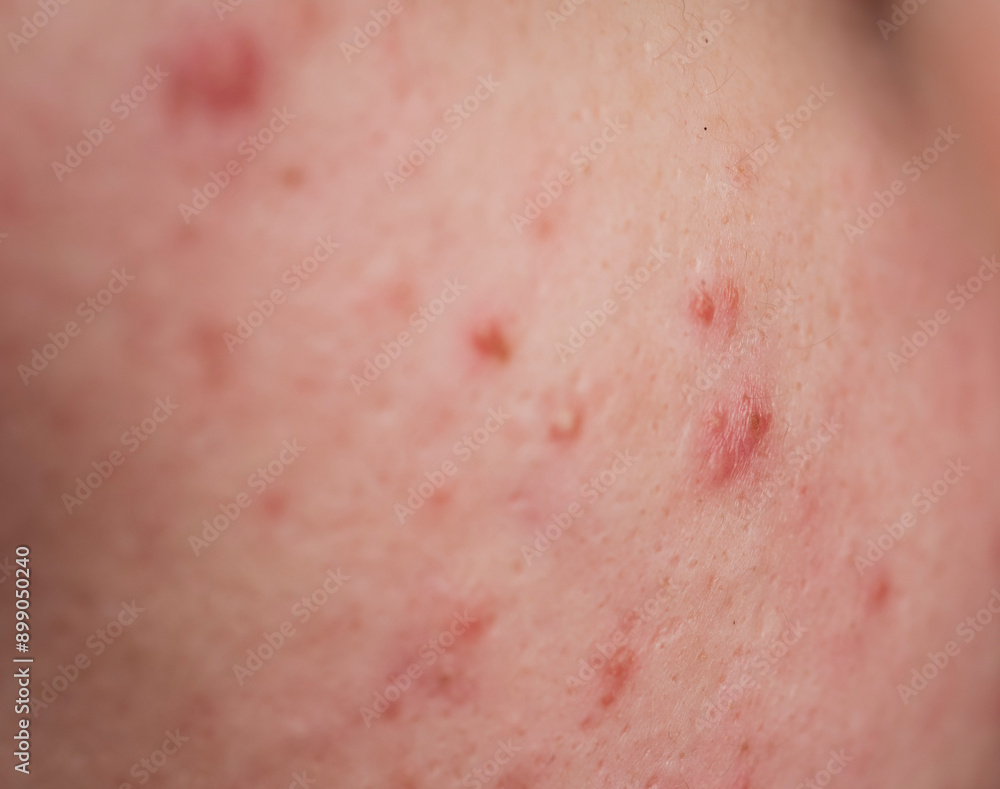 Fototapeta premium Skin texture background. Closeup acne pimple. Treatment for skin. Problem skincare. Pimples, acne, pores, scars. Natural skin. Skin care concept. Acne treatment. Pimples on face. Acne and pimple on