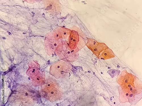 Paps smear: NILM with reactive cellular changes associated with inflammation.
