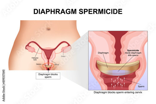 Diaphragm spermicide woman contraceptive cup illustration
