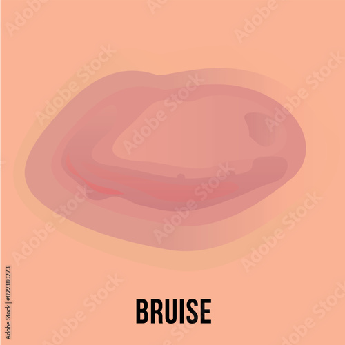 Understanding skin diseases through detailed depiction of bruise on human skin during daylight hours