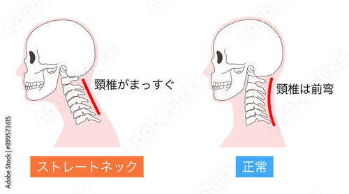 ストレートネックと正常な頸椎と頭蓋骨の比較イラスト
