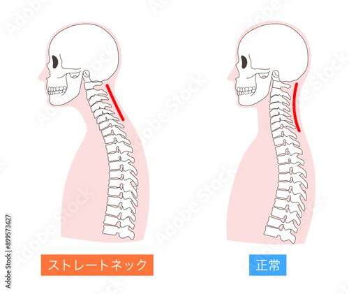 正常とストレートネックの上半身の比較イラスト