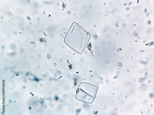 Fotografija Uric acid crystals and calcium oxalate monohydrate under microscope