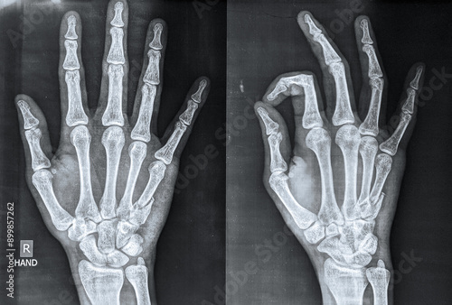  X ray of hand showing fifth metacarpal fracture, a common sports injury called boxer’s fracture 