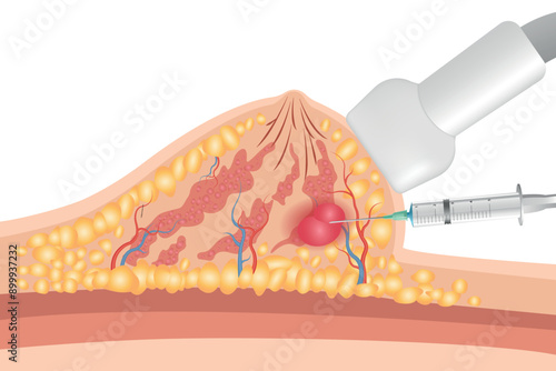 Breast cancer medical vector diagram with a cross-section of female breast anatomical structure and illustration of malignant breast tumor affected by cancer