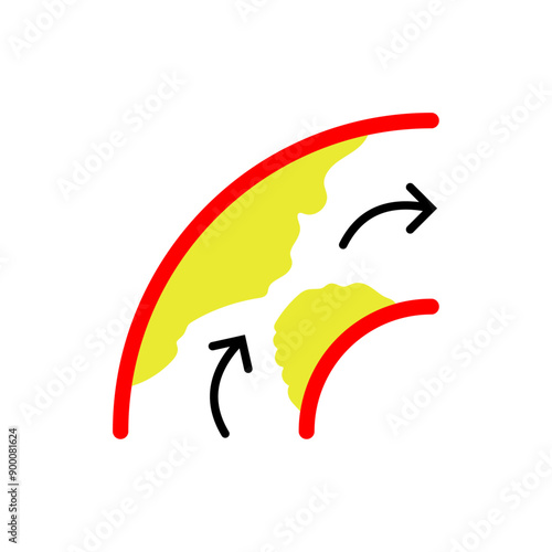 Stroke and Cholesterol Disease