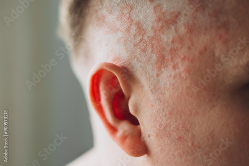 Fotografia Psoriasis on the skin close-up, scalp, photos of dermatitis and eczema, skin pro