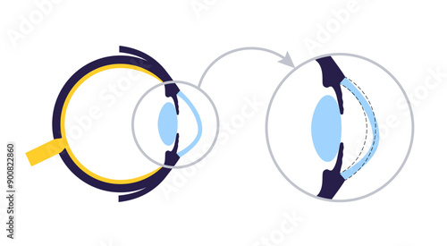Cataract eye disease