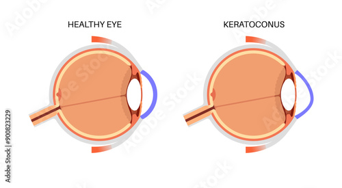 Cataract eye disease