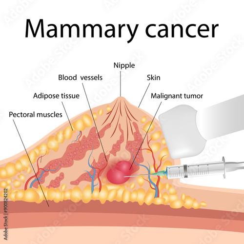 Diagnostic biopsy of breast cancer to obtain a sample. Lateral cross-sectional view of a human female breast showing a mammary gland and an unknown cyst in the fatty tissue