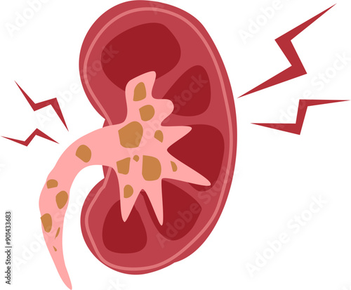 Kidney disease Illustration