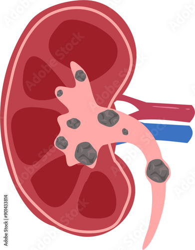 Kidney disease Illustration