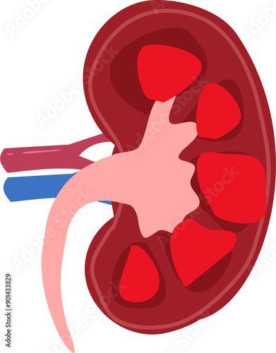 Kidney disease Illustration