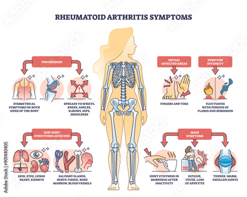 Rheumatoid arthritis symptoms with joint inflammation disease outline diagram, transparent background. Labeled educational chronic illness description scheme.