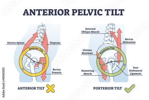 Anterior pelvic tilt model compared with posterior labeled outline diagram, transparent background. Educational scheme with skeletal bone location and movement angle illustration.