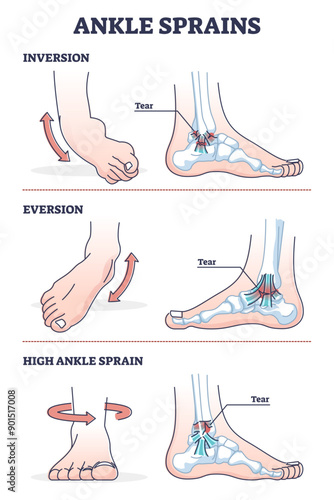 Ankle sprains situations with inversion and eversion injury outline diagram, transparent background. Twisted foot or leg pain and swollen inflammation cause.