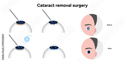 Cataract removal surgery before and after surgery