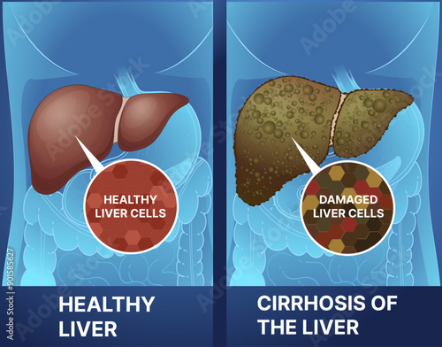 Human liver disease. Healthy liver, cirrhosis of the liver. Healthcare illustration. Vector illustration.