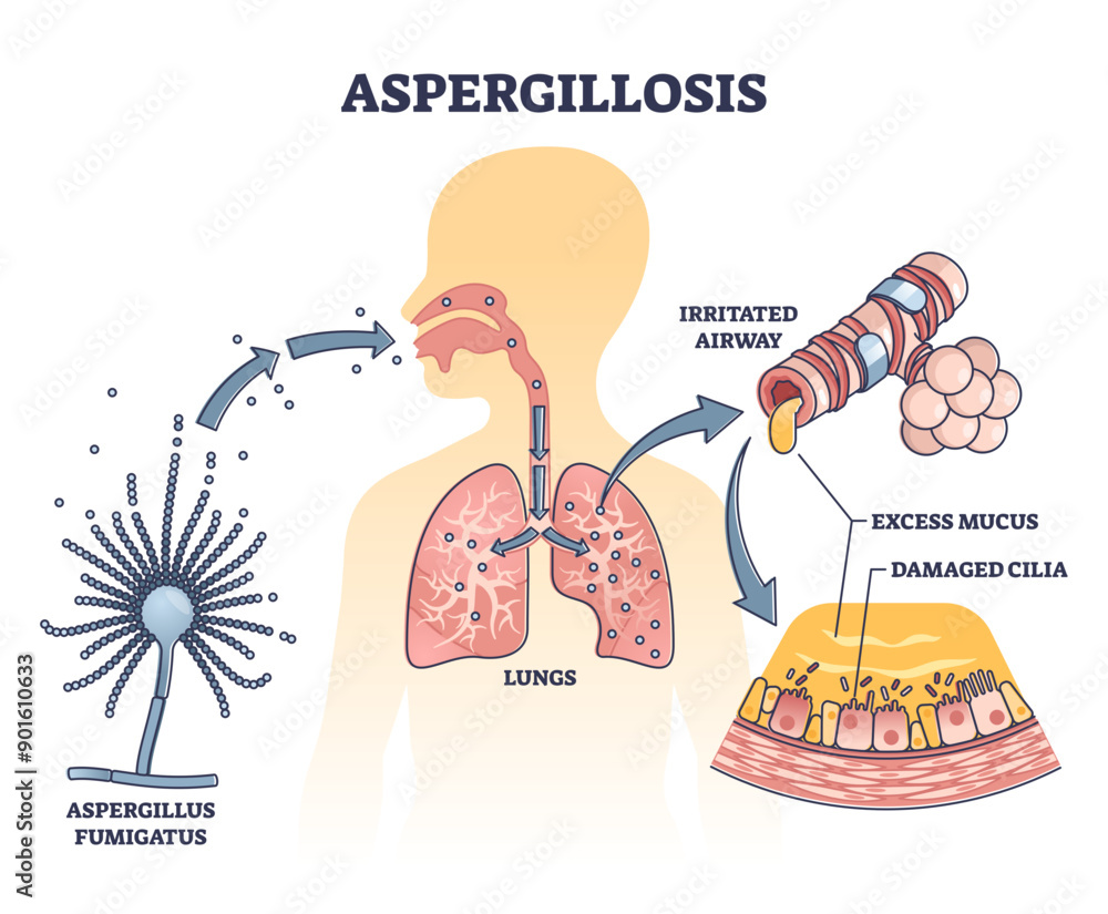 Obraz premium Aspergillosis lung infection caused by Aspergillus, outline diagram, transparent background.Irritated airway, excess mucus and damaged cilia caused by common mold fungus spores.Microbiological danger.