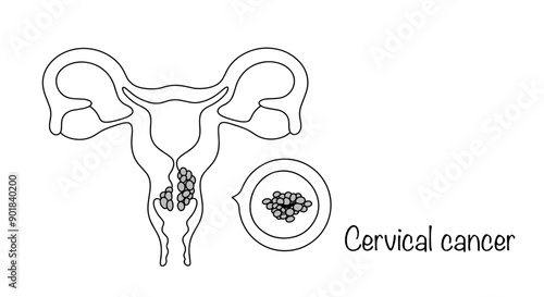 Cervical cancer