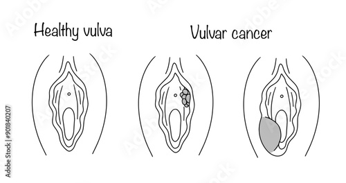 Vulvar cancer