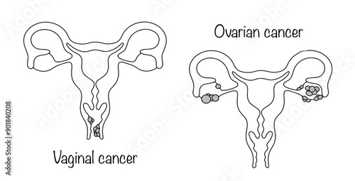 Vaginal cancer