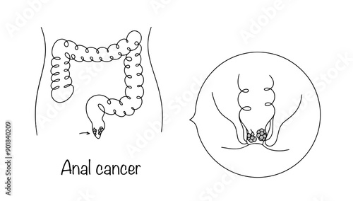 Anal cancer