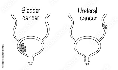 Bladder cancer. Ureteral cancer