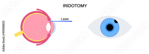 Iridectomy medical poster